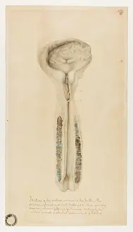 Bulb: Stricture of the Urethra Anterior to the Bulb