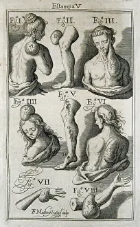 Tumour: SUAREZ de RIBERA, Francisco (s.XVIII). Spanish