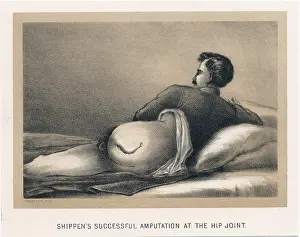 Procedure: Successful amputation at the hip joint on casualty