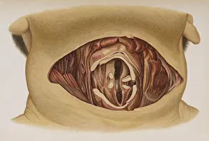 Throat: Suicide by Cutting the Throat, 1898