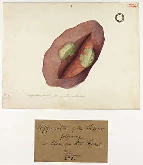 Liver: Suppuration of the Liver