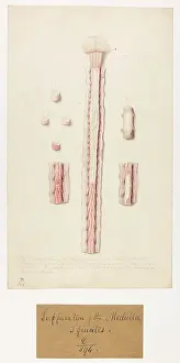 Suppuration: Suppuration of the Medulla Spinalis