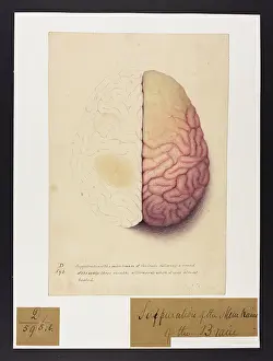Afterwards: Suppuration of the Membranes of the Brain