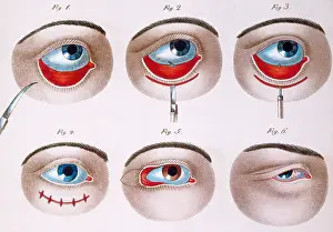 Correction: Surgery to Correct Lazy Lower Eyelid, c, 1830