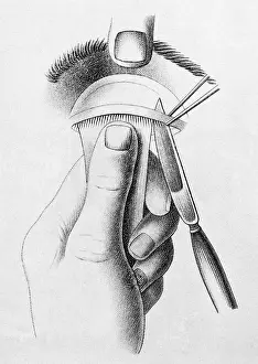 Correction: Surgery to Correct Lazy Upper Eyelid, c, 1830