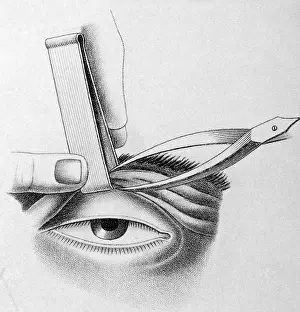 Correction: Surgery to Correct Lazy Upper Eyelid, c, 1830