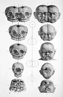 Deformed: Surgical Anatomy, 1856
