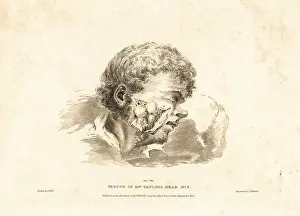 Expose: Surgical excision of the tumor in the cheek of Mr Taylor