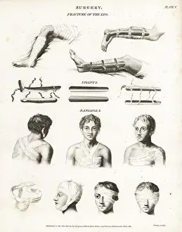 Splints: Surgical procedures from the 19th century
