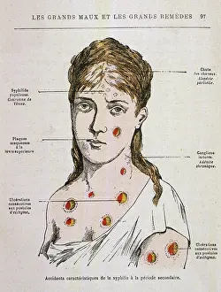 Rash: SYPHILIS/1883