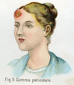 Tumour: Syphilis, Gumma periostale, 1902
