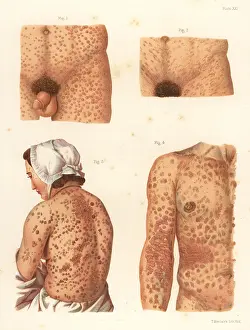 Bumstead: Syphilis symptoms on the body