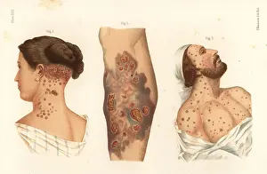 Eruptions: Syphilis symptoms on the body