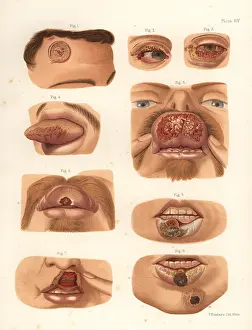 Bumstead: Syphilitic chancres on the face