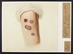 Syphilitic: Syphilitic Pustular Eruption of Skin