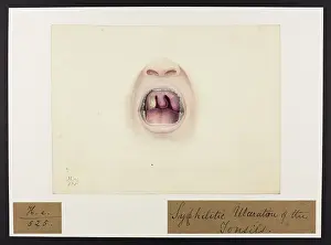 Hospice: Syphilitic Ulcerations of Tonsils