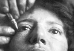 Eyelids: TATTOOING AN EYELID