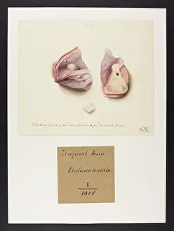 Portion: Temporal Bone: Cholesteatoma