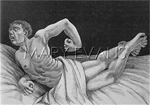 Convulsions: TETANUS VICTIM - 3