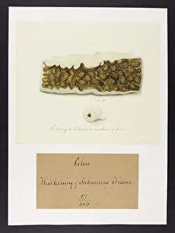 Colon: Thickening of Submucous Membrane of Colon