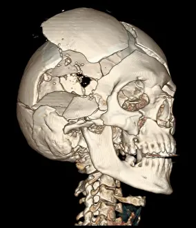 Forensic: Three-Dimensional CT Reconstruction, Skull with Bullet Wound