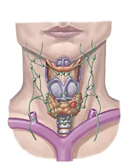 Gland: Thyroid Nodule, Illustration