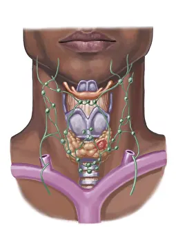 Gland: Thyroid Nodule, Illustration
