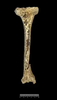 Tibia: Tibia of Achondroplastic Dwarf
