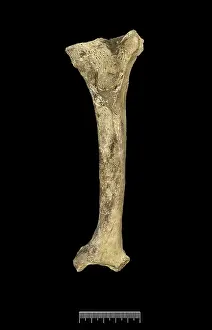 Tibia: Tibia of Achondroplastic Dwarf