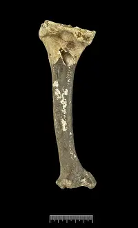 Tibia: Tibia of Achondroplastic Dwarf