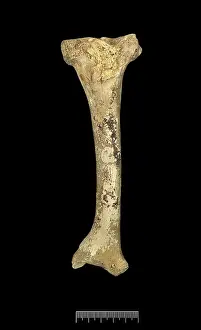 Tibia: Tibia of Achondroplastic Dwarf
