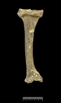 Tibia: Tibia of Achondroplastic Dwarf