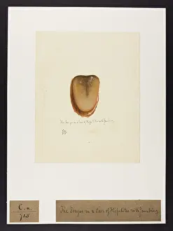 Ucl Library Services Digital Collections: The Tongue in a Case of Hepatitis