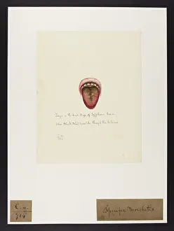 Ucl Library Services Digital Collections: Tongue in the Last Stage of Typhus Fever
