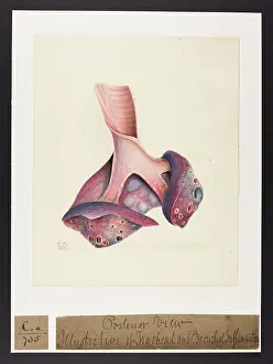 Bronchial: Tracheal and Bronchial Inflammation
