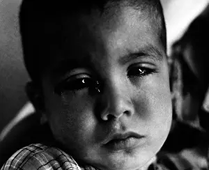 Trachoma: Trachoma. A young a young child with flies around