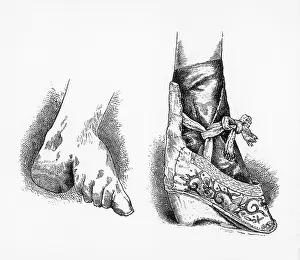 Deformed: Traditional Chinese Foot-Binding