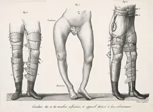 Straighten: TREATING BOW LEGS (2)