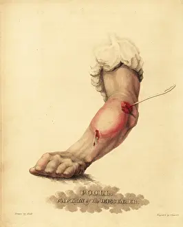 Ulcers: Treatment of an abscess in the forearm, 1815