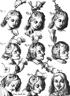 Trephination: Trepanning, 1666
