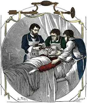Trephination: Trepanning, 19th Century