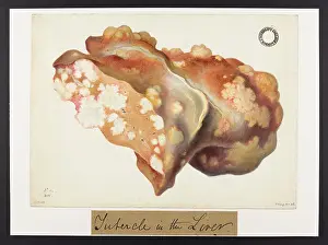 Liver: Tubercle in the Liver