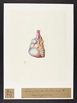 Tubercles: Tubercles on Epidydimis and Vas Deferens