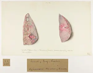 Ulceration: Tubercles: Inflammation and Ulceration of Bronchi
