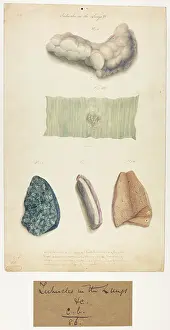 Lungs: Tubercles in the Lungs