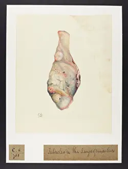 Lungs: Tubercles in Lungs