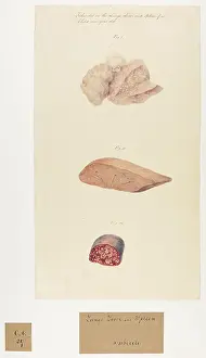 Liver: Tubercles in the Lungs, Liver and Spleen