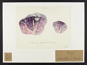 Femmes: Tubercles and Modes of Cure: Tubercular Phthisis
