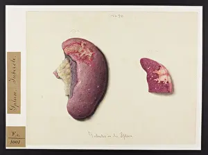 1831: Tubercles in the Spleen