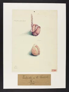 Tubercles: Tubercles in the Testicle